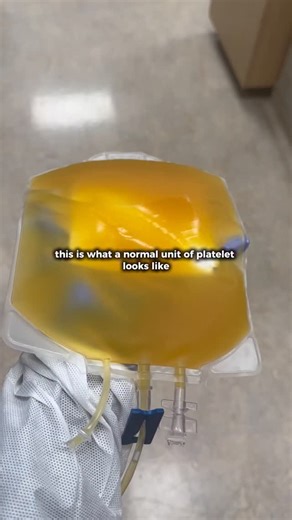 Marilyn | CLS MLS(ASCP) on Instagram: "Have you ever seen fat in a blood product? 👀🩸🍔 Let’s compare a normal bag of platelets with a lipemic bag of platelets, and yes, they can look very different. Platelets are transfused to prevent or treat bleeding in patients with low platelet counts or platelet dysfunction, especially in oncology patients, trauma, surgery, and bone marrow transplant settings. Lipemia refers to the presence of excess lipids in the plasma, which gives blood products a clou