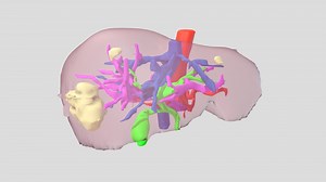 Liver with segment 5/8 tumour - 3D model by TVASurg