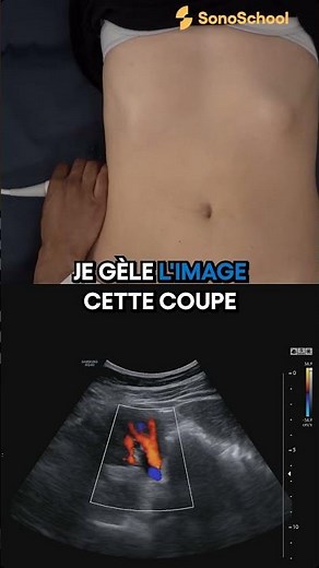 Échographie des reins : coupe transversale et mesure du pelvis – iSonic | SonoSchool