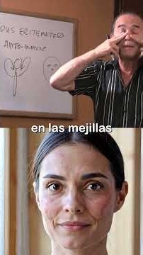 Mejora el Lupus Naturalmente