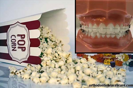 Can You Eat Popcorn With Braces? [With Alternatives] - Orthodontic Braces Care