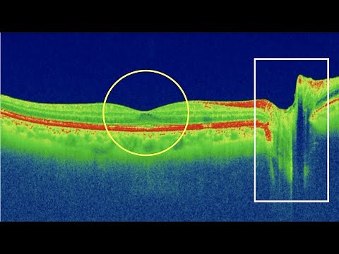 Capas de la retina en OCT