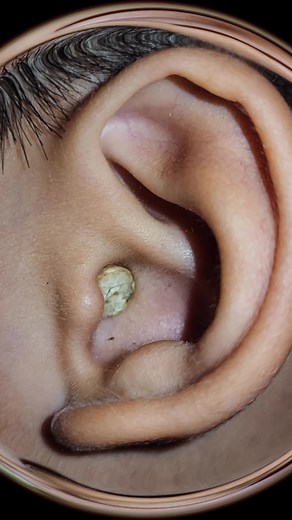 Effective Ear Cleaning Techniques Using Ear Picks