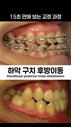 하악 구치 후방이동 Mandibular posterior molar distalization