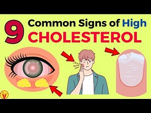 9 Common Signs of High CHOLESTEROL You SHOULD NOT Ignore | VisitJoy
