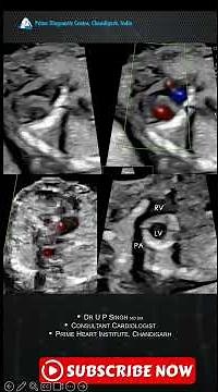 The Heart calcified? Rare Fetal Myocardial Calcification Explained!