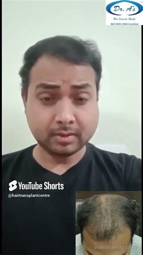 Best Hair Transplant in Delhi | Best Results & cost of Hair Transplant in Delhi