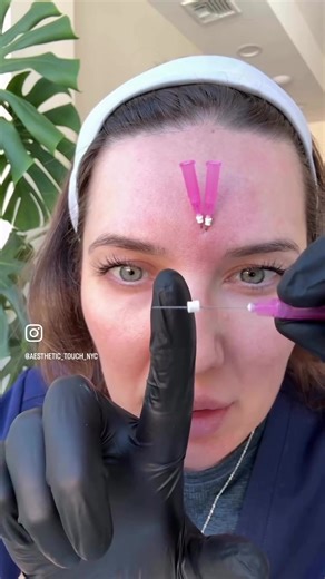 PDO Screw threads are the best for existing deep wrinkles. They’re a safe, effective method of eliminating unwanted indentation while providing strong structure and collagen stimulation to the skin when they dissolve. #threads #wrinkles #antiaging #collagen #brooklynmedspa