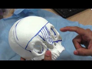 Hypertelorism surgery planning using 3D printed model