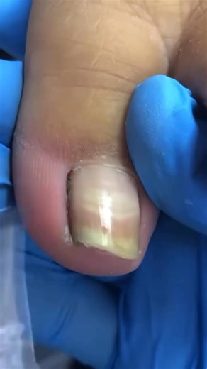 Professional toenail cutting that brings instant relief ✨#ToenailTreatment #ToenailCleaning #FootHealth #BeforeAndAfter #NailTransformation | ADN Medical