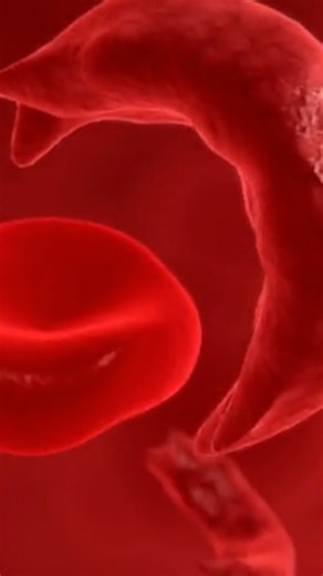 FDA approves 2 breakthrough treatments for those living with sickle cell disease