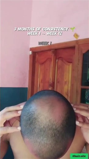 Best Treatment for Bald Men | Hair Loss Solution That Actually Work. #Bald #BaldProblem #Menbaldness