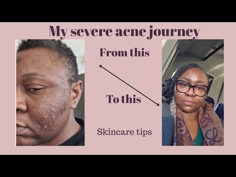 My severe acne journey. How I take care of my acne prone skin.