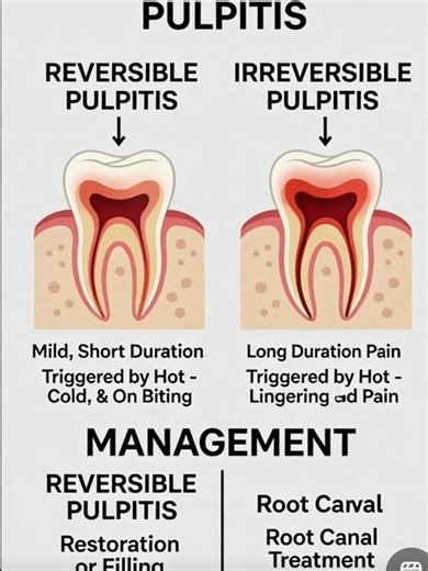 #Pulpitis 😡 #Types and clinical features #Treatment 🙂