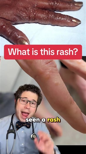 What is this rash? What is dyshidrotic eczema? #rash #eczema #tiktokdoc #learnontiktok