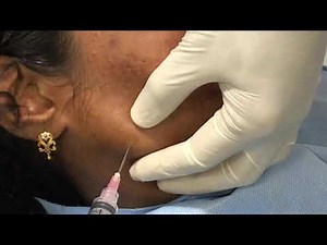 Needle aspiration