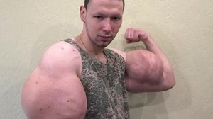 'Russian Popeye' who injected oil into biceps hospitalised after sparking major health fears
