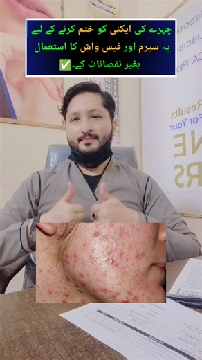 get rid of face acne | #facepimples #acne #trending #shortvideo #viralshortvideo