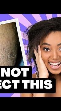 EXTREMELY SATISFYING Ingrown Hair Removal 😌