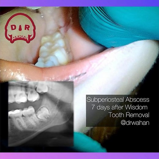 Abscess a Week after Wisdom Tooth Removal Drained with Perio Probe