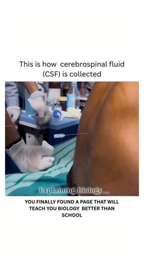 Explaining Biology on Instagram: "Cerebrospinal Fluid (CSF) collection — a vital procedure done through a lumbar puncture to analyze brain and spinal health. This clear fluid gives doctors key insights into infections, bleeding, and neurological disorders. CSF (Cerebrospinal fluid) collection is a medical test where a small amount of the fluid surrounding the brain and spinal cord is removed for analysis. The most common method is a lumbar puncture (spinal tap), performed by inserting a needle i