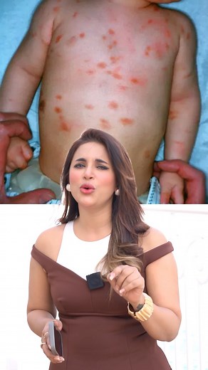 Papular Urticaria: কারণ, লক্ষণ এবং চিকিৎসা #drmiami #sedonaaesthetic #papularurticaria | Dr Miami