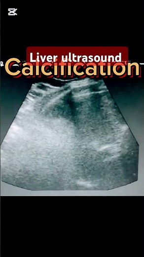 How to see liver and calcification ultrasound #science #nursing #education #live #liver