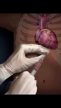 PERICARDIAL EFFUSION || Pericardiocentesis || Increased pericardial fluid || by Dr Raj Mishra #best