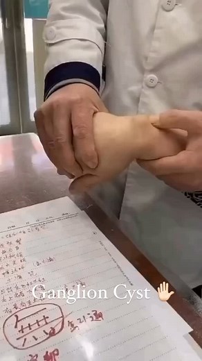 A non-cancerous lump, often on the tendons or joints of wrists and hands. The cause of ganglion cysts is unknown. A ganglion cyst is round, small and usually painless. Although rare, it can be painful if it presses a nerve. In a few cases, the cyst can interfere with joint movement. A ganglion cyst often clears on its own. If troublesome, it can be drained or removed. | Mobile By Australian Allied Health Network