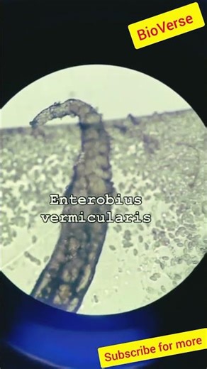 “Enterobius Vermicularis | Pinworm Infection Explained 🦠”