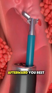 #How #bronchoscopy #doctor #scope #screen #flexible #tube #relax #medical3danimation #3dmedicalanimation | Medcare777