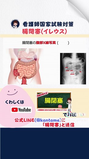 腸閉塞のエックス線画像と治療方法の解説