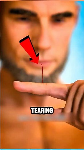If You Ever Rip Off a Hangnail, This Could Happen to Your Finger 😨