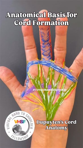 Anatomy of Dupuytren’s cords. This video summarizes fascial anatomy relevant to cord development in Dupuytren’s disease, based on a presentation by Charles Eaton, MD, at the 2017 Annual Meeting of the American Society for Surgery of the Hand. We’re covering Dupuytren’s this weekend with the January 2025 Virtual Hand Therapy Fellowship cohort, as they approach the conclusion of their fellowship year. We’re also welcoming new enrollees for the January 2026 cohort. Early enrollment offers reduced t