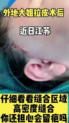 Ear Surgery Recovery: 17 Days Post-Procedure