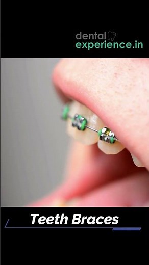 Affordable | Metal braces | Ceramic Teeth Braces | Clear Teeth Aligners Cost in Kochi, Kerala, India