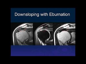 Shoulder | Impingement Part 1