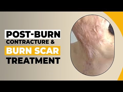 How do you Treat Burn Scars from Contractures? Surgical Treatment of Burn Scars, Dr. PK Talwar