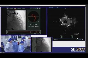 Live Case: CTO and Complex Coronary Cases