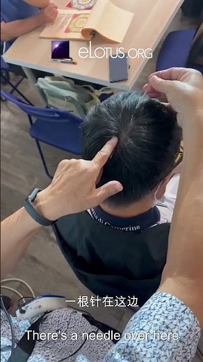 FREE CEUs on LIVE Scalp Acupuncture Webinar! Learn powerful techniques