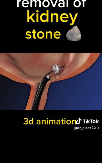 REMOVAL OF KIDNEY STONES; (3D ANIMATION) #kidneystone #kidneystones #kidneyfailure #kidneydisease #kidneystonesurvivor #kidneystoneremoval #kidneystonerecovery #kidneystonesurgery #3dmedicalanimation #medical3danimation