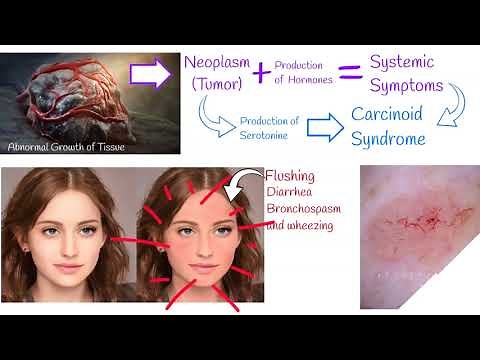 Carcinoid syndrome - Symptoms and treatment. Carcinoid Heart Disease