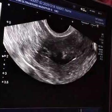 How to measure Endometrium