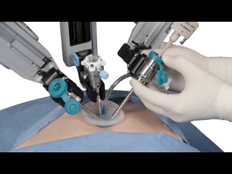 Robotic Gallbladder Surgery - David Lourie MD