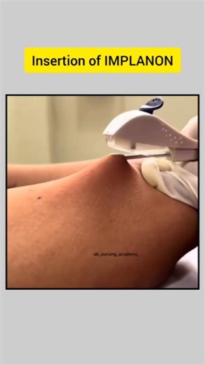 Ak Nursing Academy on Instagram: "Implanon is a progestin-only contraceptive implant inserted under the skin of the upper arm to prevent pregnancy for up to three years. It works by releasing etonogestrel to prevent ovulation, thicken cervical mucus, and thin the uterine lining. While highly effective, potential side effects include changes in bleeding patterns, acne, headaches, and moodiness, with insertion and removal performed by a trained healthcare provider Implanon is inserted under the sk