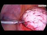 Laparoscopic Myomectomy For Intramural Fibroid • Video • MEDtube.net