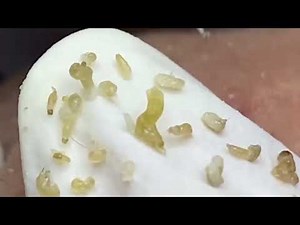 Relaxing Acne & Blackhead Removal | Satisfying Pimple Popping & Skin Care