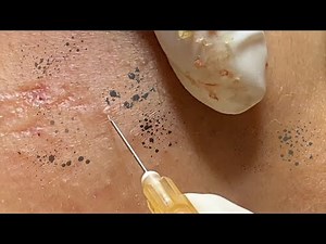 Lots of Acne Extraction | Deep Pore Cleaning & Stubborn Buildup Removal – Spa Linh Mun #80