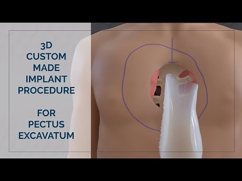 3D Custom-made implant procedure for Pectus Excavatum