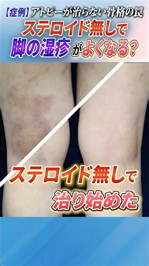 Can Atopic Dermatitis Improve Without Steroids? The "Skeletal" Root Cause Behind Medication Failu...